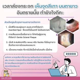 จุดสีเทาบนตา คืออะไร?? น่ากลัวมั้ยนะ